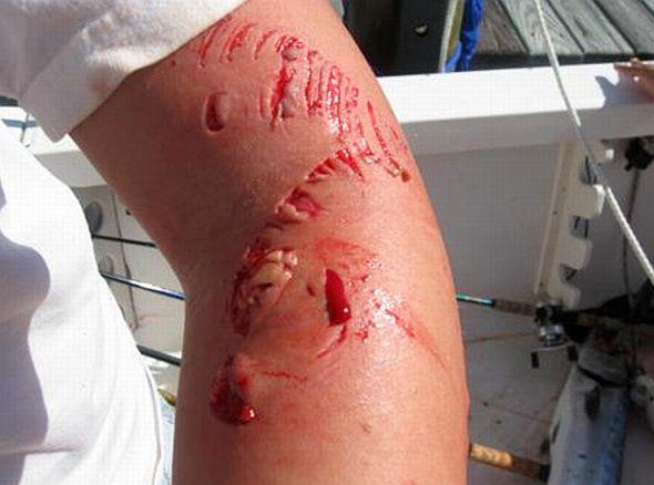 amazing fish - 62severe-arm-injury-from-barracuda1.jpg
